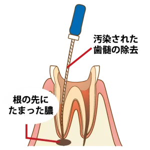 根管治療とは？