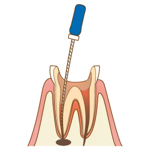 根管内の汚染された組織を徹底的に除去します。これには数回の治療が必要になります。