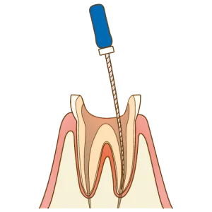 根管内を丁寧に洗浄して消毒します。
