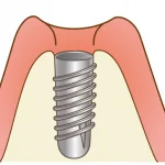 インプラント