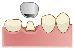 クラウン(歯冠)